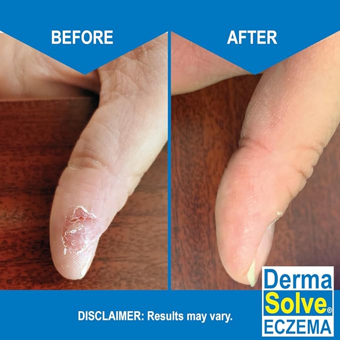 Dermasolve Eczema Relief Body Wash (2 Pack) | Protects, Moisturizes, and Repairs Skin - Kids, Babies & Adults - Steroid Free