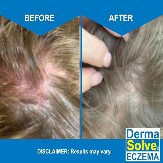 Eczema Shampoo & Conditioner (Combo Pack) - Flare Control Scalp & flake Relief Therapy that Protects, Moisturizes, and Repairs Skin by DermaSolve - Kids & Adults - Steroid Free